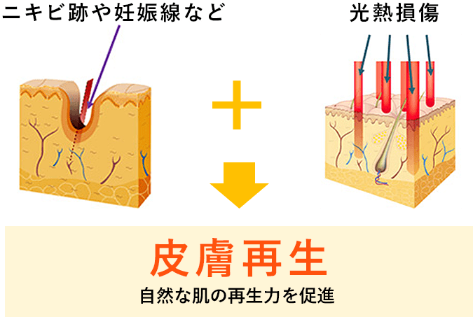 施術イメージ