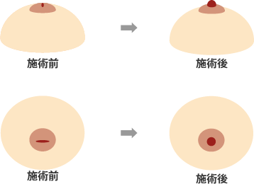 陥没乳頭の治療について